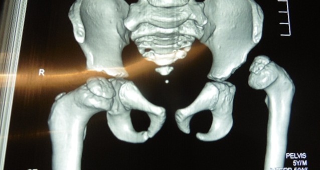 Médicos del Lorena realizaron alta cirugía de luxación congénita de cadera de niño de 5 años